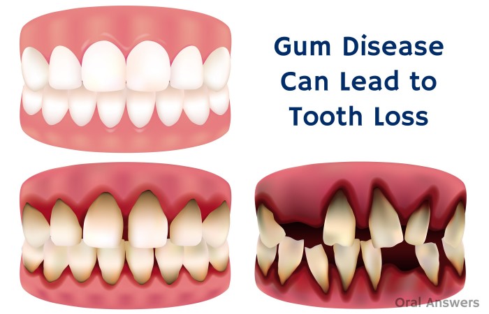 teeth tooth disease loss cause gum periodontal loose lose problems lost cavities condition leading dental oral healthy perfect