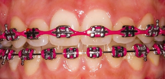 braces chain rubber bands