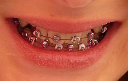 red colored braces