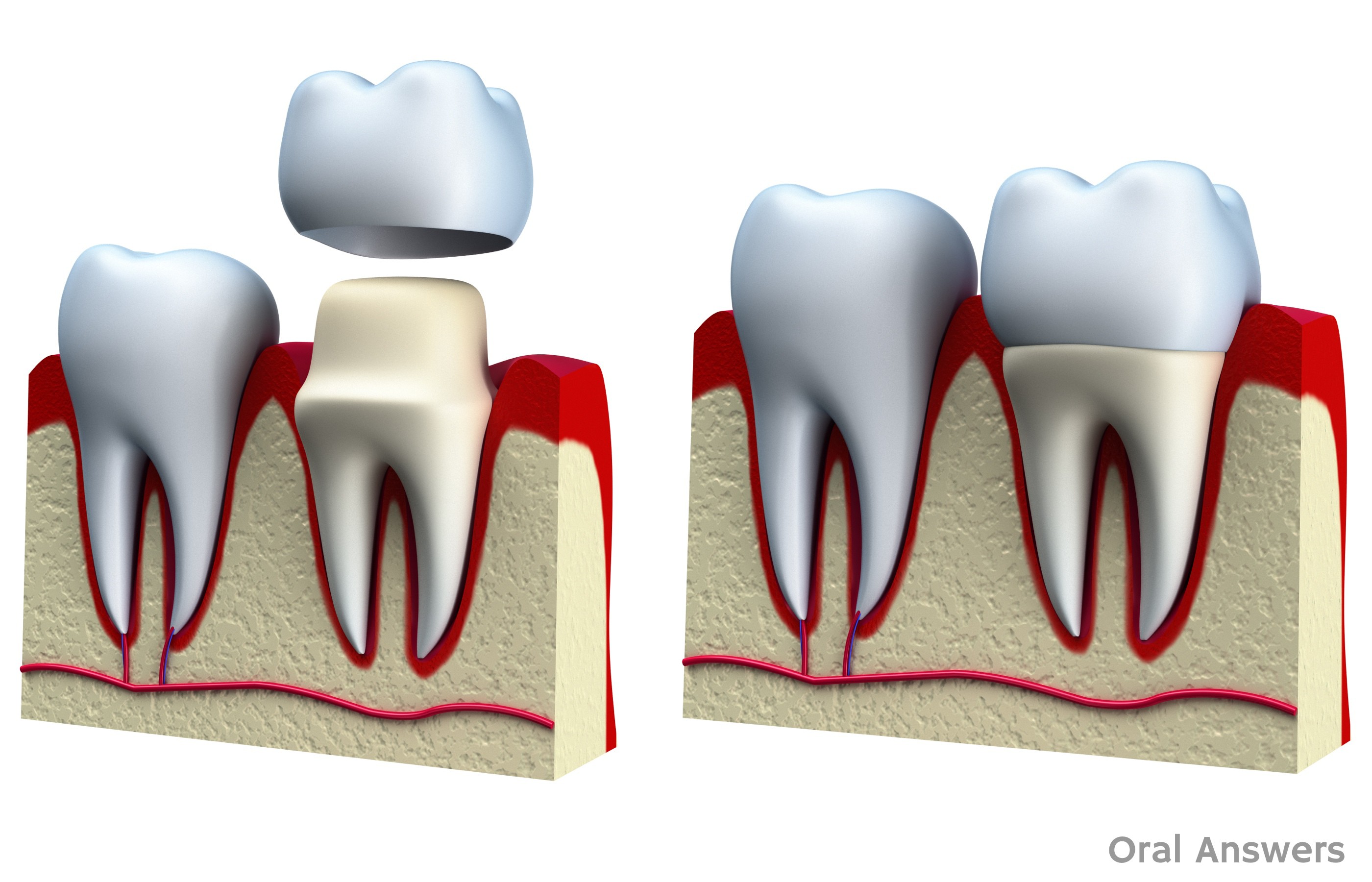Image result for dentist crown