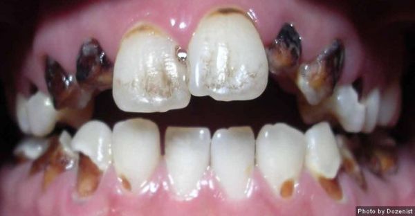 Meth Mouth The Effects Of Methamphetamine On Your Teeth Oral Answers