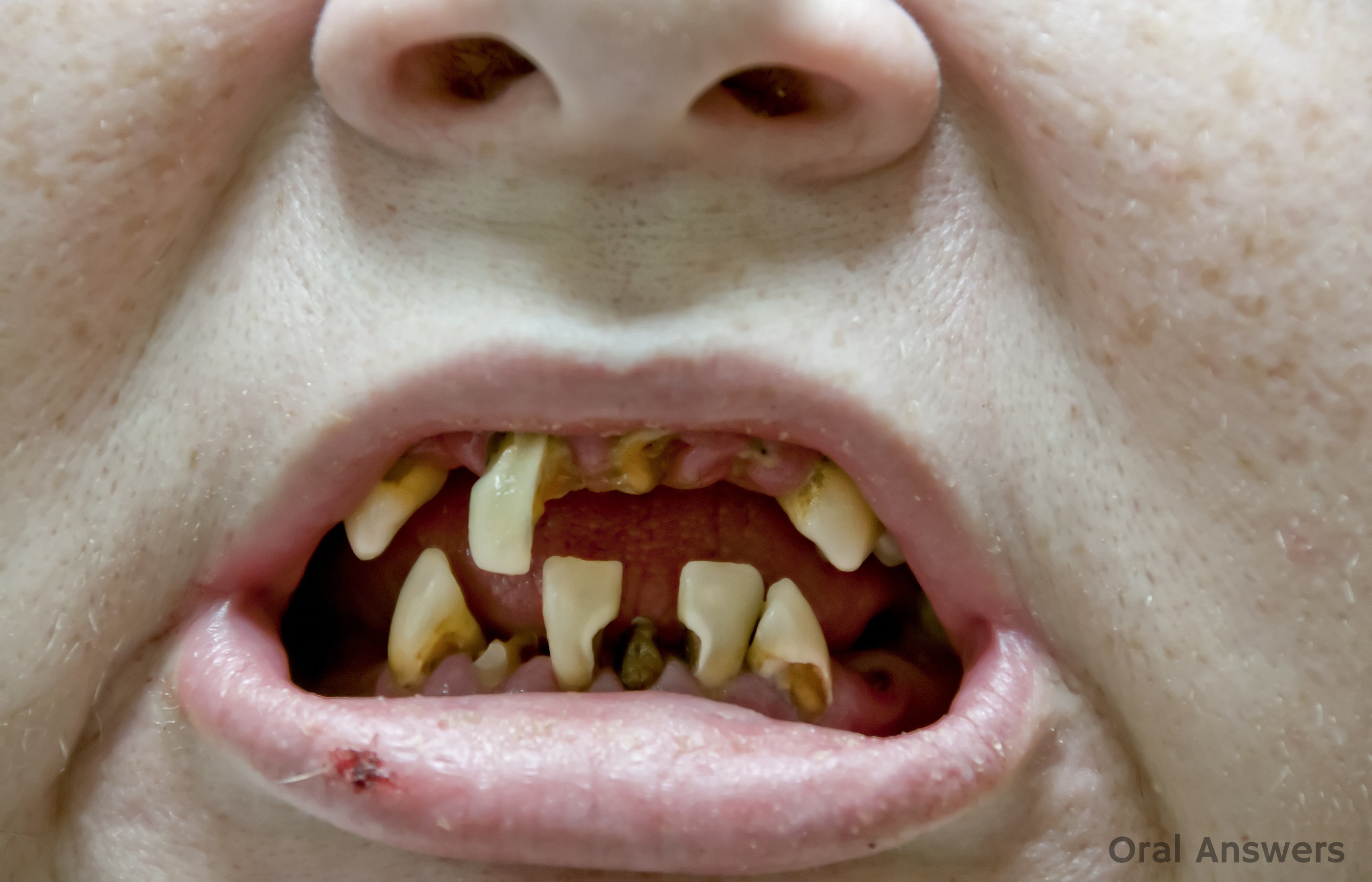 faces of meth teeth
