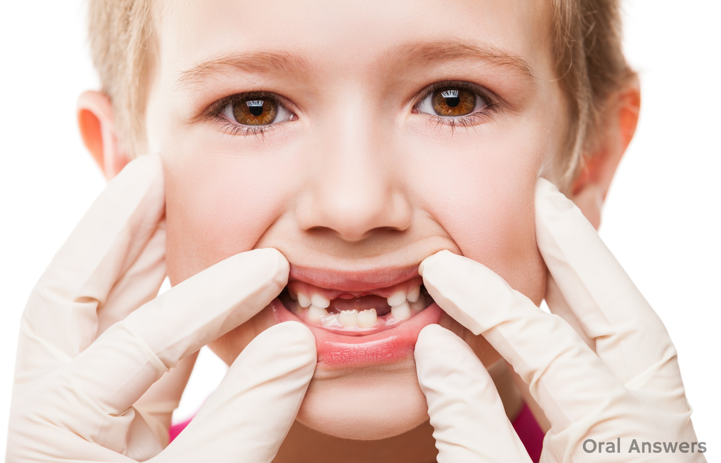 Cavities In Baby Teeth Should You Get Baby Teeth Filled Oral Answers