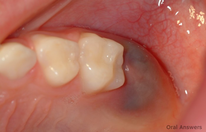 Eruption Cyst Upper Back Molar