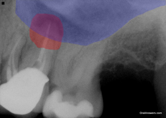 Can A Sinus Infection Be Caused By A Tooth Oral Answers