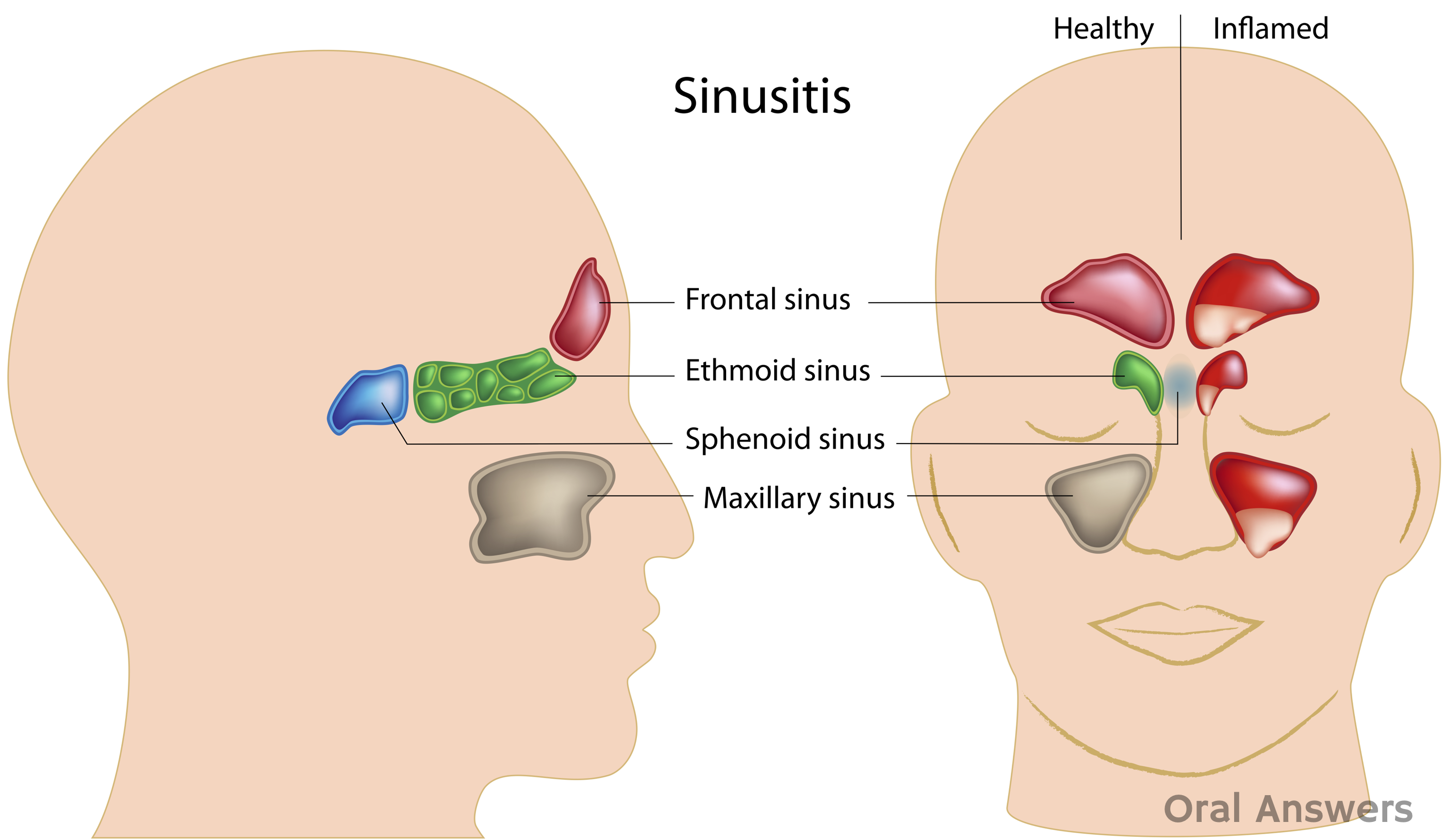 Diagram Of Sinuses And Throat