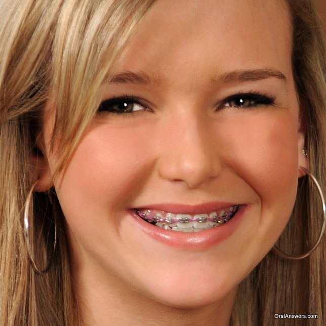 Teen Girls With Braces Facial - 60 Photos of Teenagers with Braces | Oral Answers