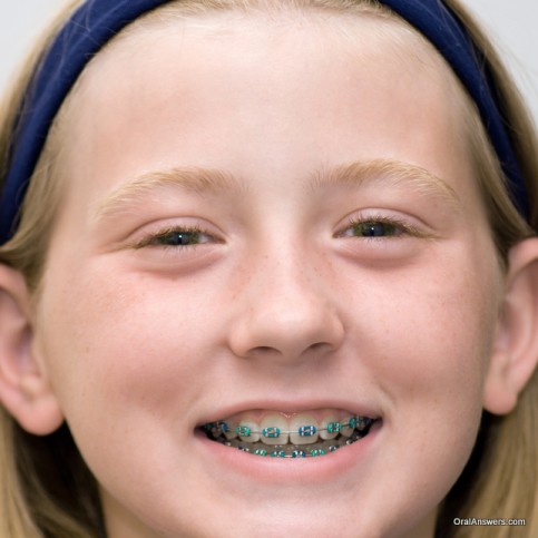 60 Photos of Teenagers with Braces | Oral Answers