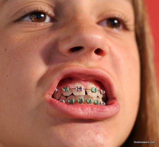 Teen braces swallow