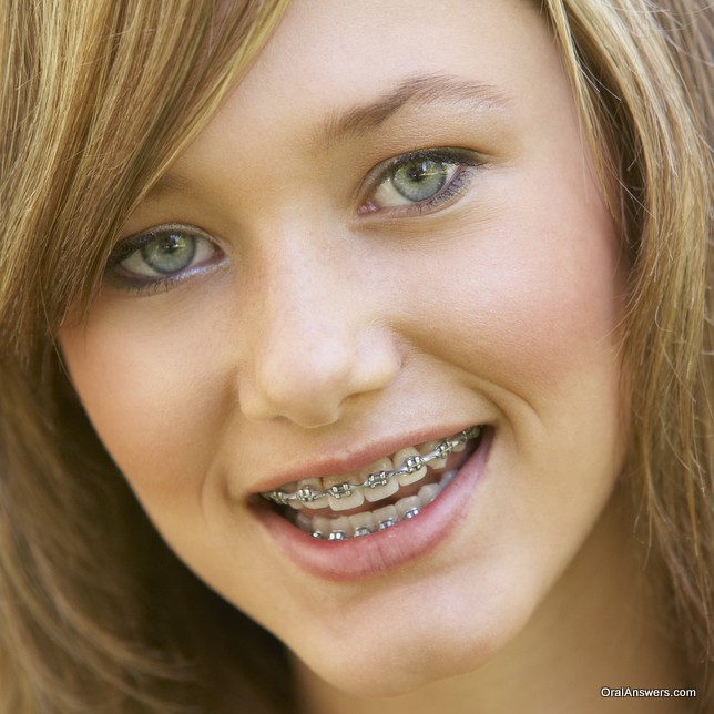 Horny teen girl with braces free porn pictures