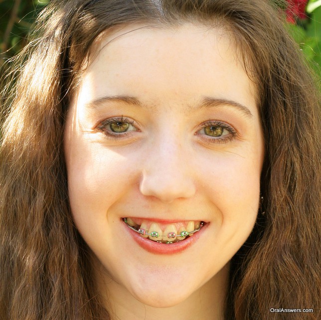 Horny teen girl with braces free porn pictures