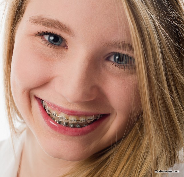 60 Photos of Teenagers with Braces Oral Answers