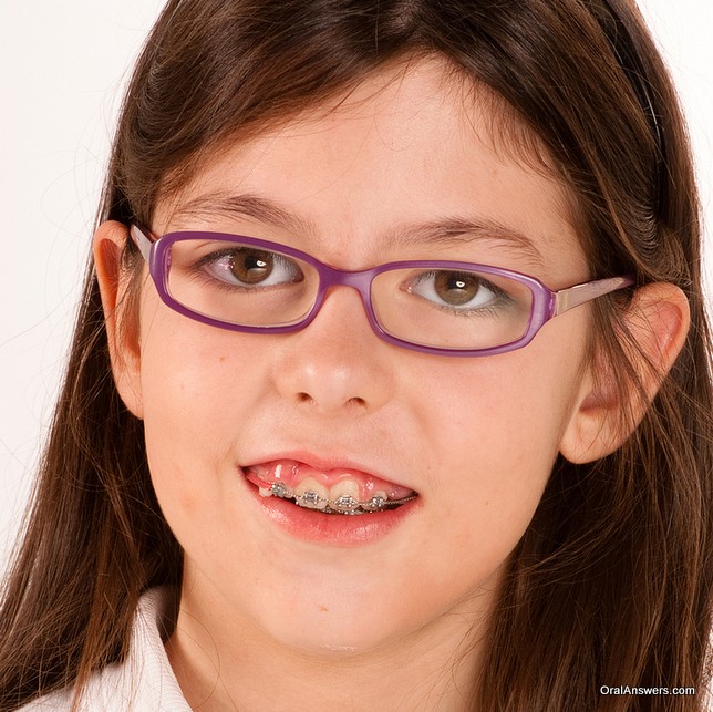 braces glasses wearing teenage purple teenagers frames taken