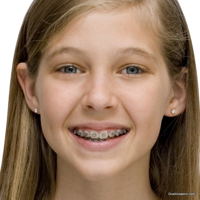 Tiny Barely Legal Girls With Braces