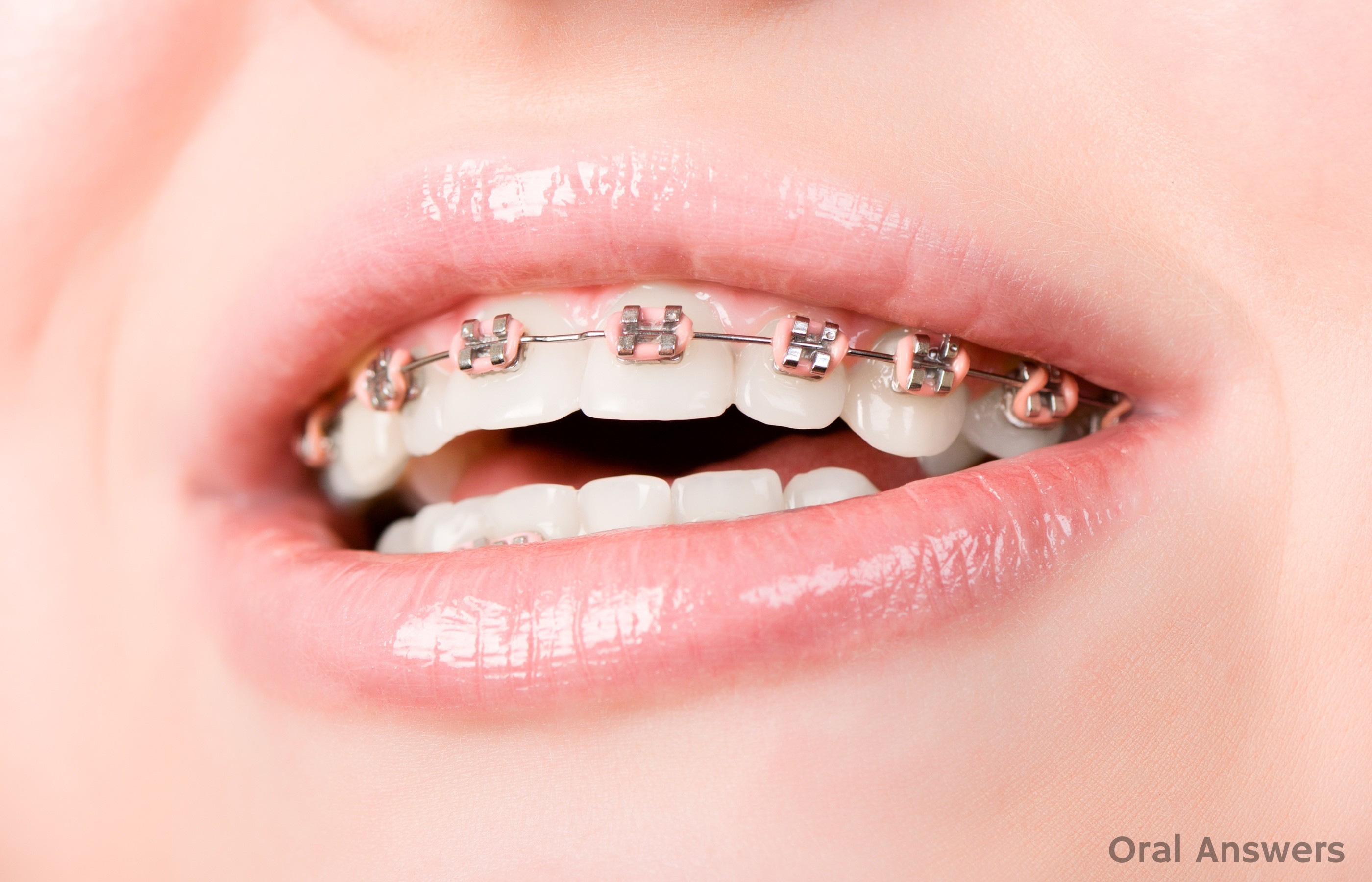 Signs You Need Braces  Orthodontic Services in Columbus, OH