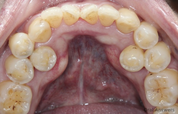 Extra Tooth Mesiodens And Other Supernumerary Teeth Oral Answers